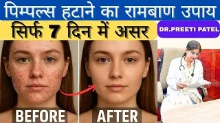 How To Remove Acne From Face in 7 days, Get Spotless Glowing Smooth Skin ,Dr.Preeti Patel