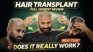 Hair Transplant in Kochi  (HX-BWWE) | Best Results & Cost of Hair Transplant in Kochi.