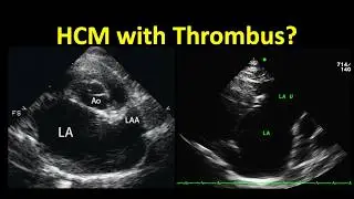 3. LA Enlargement, Thrombus & Congestive Heart Failure - Feline HCM