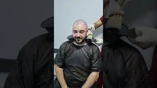 Stefan's Hair Transplant Journey in 40 Seconds | | Longevita