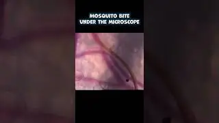 Mosquito Bite Under the Microscope #medicine #science