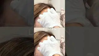 Upper Face Neuromodulator #botox #plasticandbeauty #cosmeticprocedure