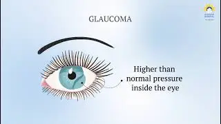 Understanding Induced Glaucoma: Recognizing Subtle Signs for Early Detection and Care #glaucoma