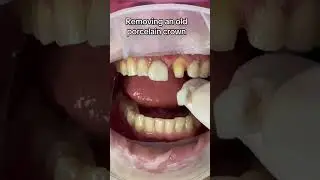 Removing old porcelain crowns #veneers #shorts #cosmeticdentistry #dentalveneers #porcelainveneers
