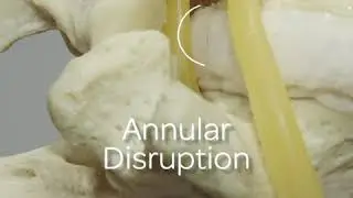 Extrusion and Protrusion Model of Disc Herniation