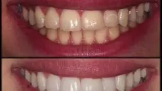 Smile Improvement // Tooth whitening, DMG Icon and cosmetic bonding by Dr Simon Chard