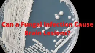 Can A Fungal Infection Cause Brain Lesions