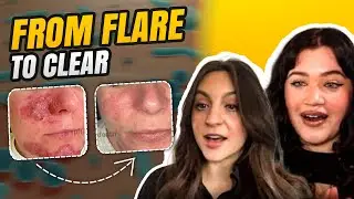 Rare Rosacea Transformation You Can't Miss (Pregnancy Case)