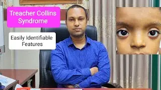 Treacher Collins Syndrome: Learn Easily Identifiable Features