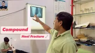Amazing Chiropractor Treatment adjustment Heel   Fracture Compound Ankle Pain refill bone JaiBhagwan