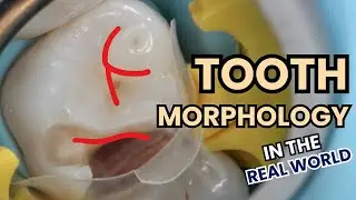 Should our Restorations Follow Textbook Anatomy? Tooth Morphology - PS005
