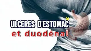 Ne laisse pas l'ulc&egrave;re gastrique te perforer l'estomac -  ULCER-CARE : traitement naturel
