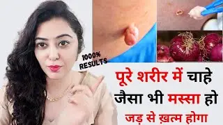 मस्से का इलाज/masse ka ilaj | मस्से Warts या Skin Tags को जड़ से हटाने के उपाय | Warts ka ilaj Hindi