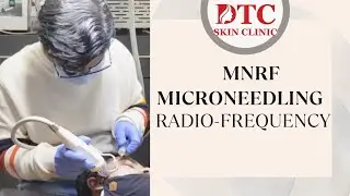 MNRF (microneedling radio-frequency)treatment @DTC skin clinic,Dr.Rohit Goel M.D. GIADA