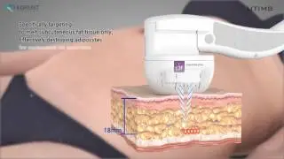 HIFU UTIMS A3 Transducer for Fat Reduction