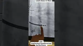 Implanted Cardioverted defibrillator lead show in floro #trending #reels #shortsfeed #shorts #short