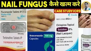 NAIL FUNGAL TREATMENT/TOENAIL FUNGUS TREATMENT/ONYCHOMYCOSIS/NAIL POLISH/FUNGAL INFECTION