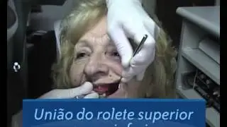 Próteses Deflex. Vídeo 12. Caso Clínico