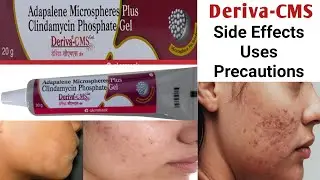 Deriva-cms gel uses in hindi । Side Effect | Precaution | Midicine Hub #Adapalene #Clindamycin
