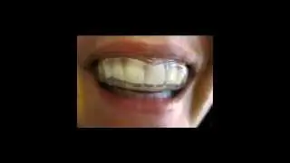 Cure For Bruxism Review - Watch Before You Buy!!