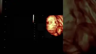 Baby Smiling During Ultrasound Will Make Your Heart Melt 