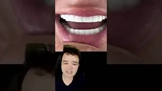 As facetas de porcelana dela deram MUITO ERRADO #shorts