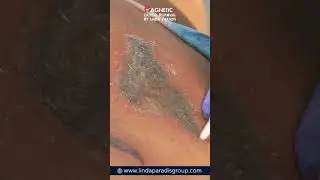 magic of Magnetic Tattoo Removal!