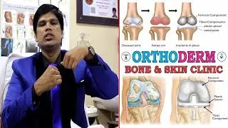 Total Knee Replacement #6 | Orthoderm Bone & Skin Clinic | Dr.S.Chinna Durai