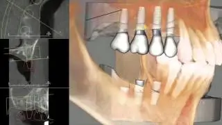 Cornerstone Dental Implants in Hillsborough New Jersey