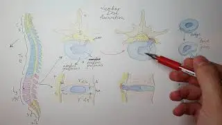 Lumbar disc herniation simple explanation