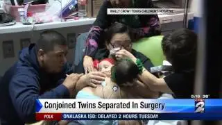 Conjoined twins separated successfully at Texas Childrens Hospital