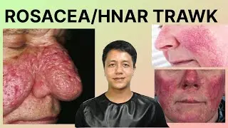 ROSACEA/HNAR TRAWK/HMAI SEN [With Subtitle]