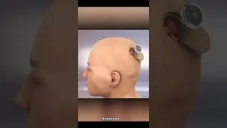 How Neuralink chip work in first person ?