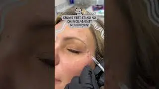 Crows Feet Stand NO Chance Against Neurotoxin