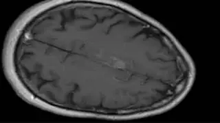 2010: New vaccine attacks brain tumor