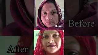 Skin care 9266414235 #pigmentation #skincare #acne #antiaging #skin #beauty #glowingskin #melasma