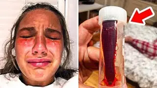 Weird Nose Lump Gets Bigger&hellip; What Doctors Found Inside Left Them Speechless!