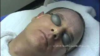 Laser Skin Resurfacing Active Fx