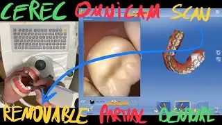 Scanning for removable denture with CEREC Omnicam