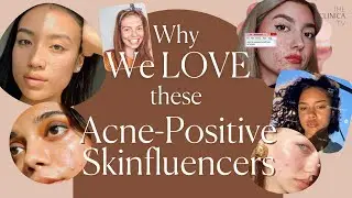 Why we LOVE these Acne-Positive Influencers on Instagram ❤️  | its.shiny, izzierodgers & more!