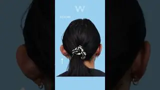 Prominent ears? Dr. Wise can pin them back with an Otoplasty ear procedure, even if it&rsquo;s just one!