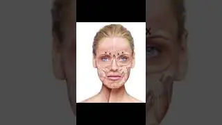 Forehead glabellar lines aka &ldquo;11&rsquo;s&rdquo; where⁉️She gets the noninvasive facelift at The Glow Clinic 💎