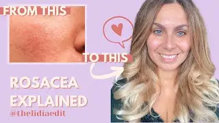 ROSACEA EXPLAINED: causes, symptoms, treatment | THELIDIAEDIT