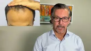 Natural hair restoration on 38 year old middle eastern man by Dr. Lindsey 3 years post op | McLean