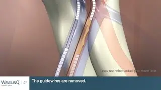 Outside U.S. only WavelinQ&trade; 4F EndoAVF System Procedural Animation (No Audio)