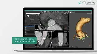 Full TAVI/TAVR planning with EndoSize | Structural Heart sizing and device selection tutorial
