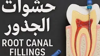 Cleaning and shaping of root canal 🦷طب أسنان مرحلة رابعة