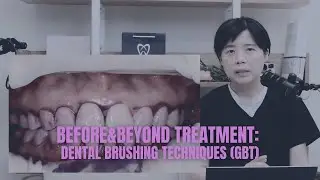 Mastering Dental Brushing Techniques (GUIDED BIOLFILM THERAPY) | BEFORE & BEYOND EP40