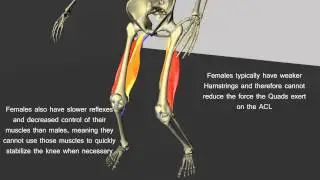 Non Contact Injury to the Anteior Cruciate Ligament