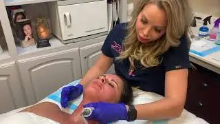 TempSure for the Neck